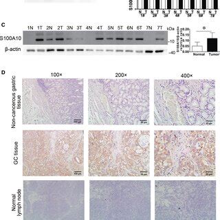 Expression Of S A In Human Gastric Cancer Gc Samples A Western