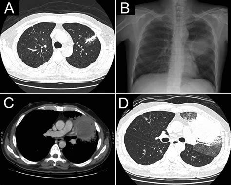 A Ct Scan Of The Chest On Admission Showing A Small Faint Patch At