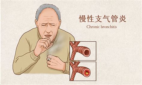 慢性支气管炎重在预防 及时治疗很关键 朴诺piping Rock健康——全面、靠谱的营养与疾病研究科学数据库