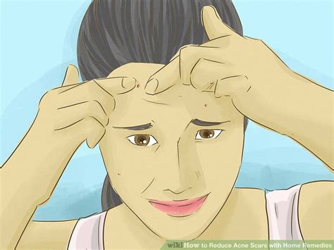 6 Ways to Reduce Acne Scars with Home Remedies - wikiHow