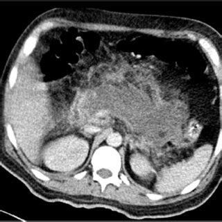 A Abdominal Ct Scan Revealing A Pancreas Increased In Size Losing Its