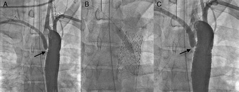 Intervencionismo En Las Cardiopatías Congénitas Del Adulto Revista