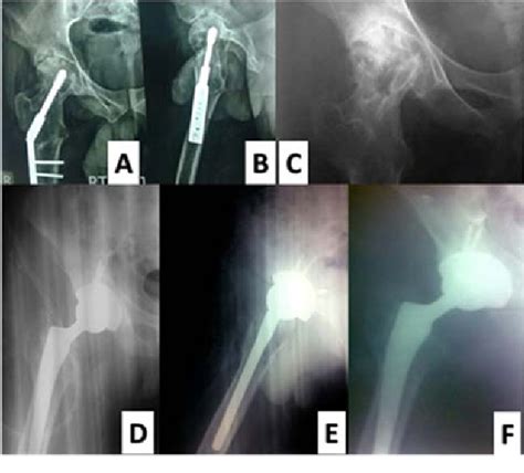 Figure 1 From Mid Term Results Of Ceramic On Ceramic Total Hip Replacement In Young Adults