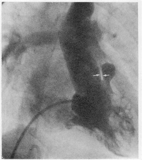 Tetralogy variation. Occasionally the infundibular septum fails to ...