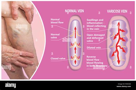 Varicose Veins On A Female Senior Legs The Structure Of Normal And