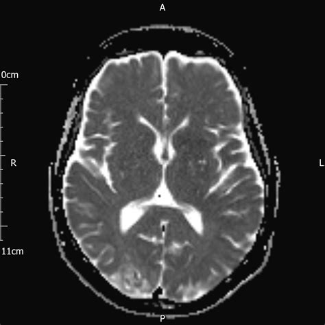 Occipital Lobe Infarct With Cortical T1 Shortening Image