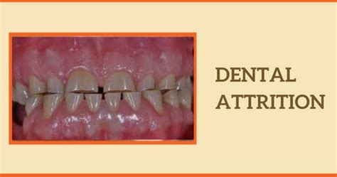 Dental Attrition: Symptoms, Causes, Treatments