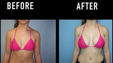 Breast Augmentation Before And After Natural Looking