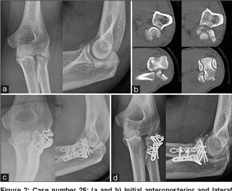 Figure From Treatment Of Modified Mason Type Iii Or Iv Radial Head