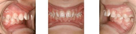 Herbst Appliance To Correct Jaw Alignment Before After Treatment Images