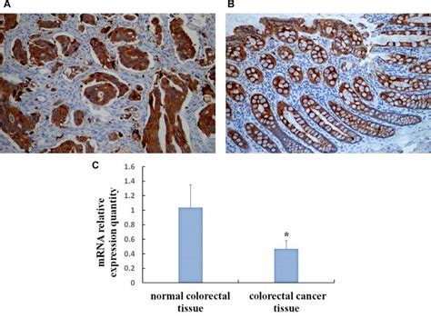 Expression Of SOCS3 In CRC And Normal Colorectal Tissue By