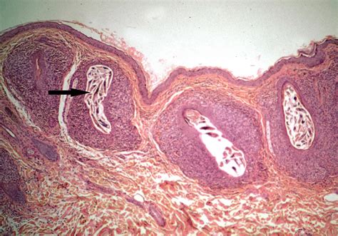 Demodex Mites