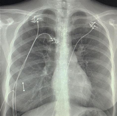 My Chest X Ray Showing My Sternum Wires After Open Heart Surgery