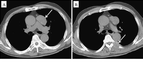 Figure 1 From A Case Of Primay Mixed Type Germ Cell Tumor Of The