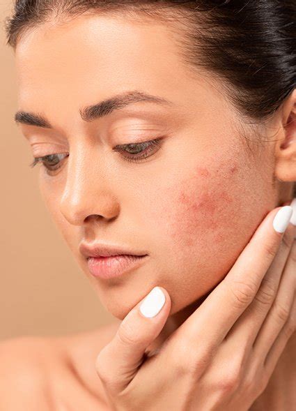 How To Get Rid Of Acne Scars Fast The Guide To Clear Skin — Griproom