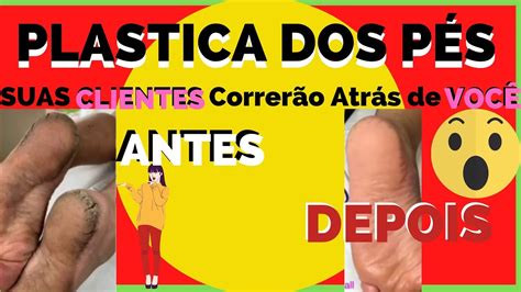 SPA Plástica nos Pés Calosidade Antes e Depois Hellen Barbosa Curso SPA