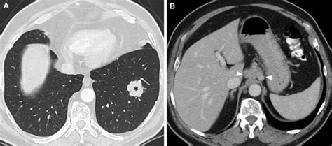 A 55 Year Old Female Patient Presented With Intermittent Hemoptysis Download Scientific