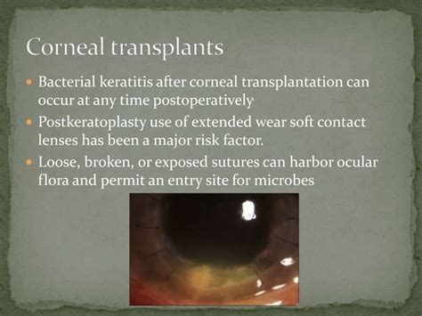 Infectious Keratitis Ppt