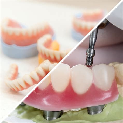 Dental Implants Vs Dentures Making The Right Choice For You Crown