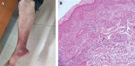 Jle European Journal Of Dermatology Silodosin Induced