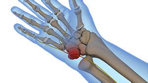 Guyon’s Canal Syndrome Seattle | Ulnar Nerve Decompression Bellevue, WA | Pacific Northwest