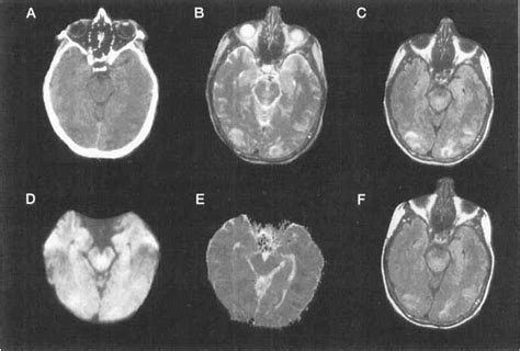 Patient 1 A Noncontrastenhanced Axial Ct Demonstrates Hypodensity In