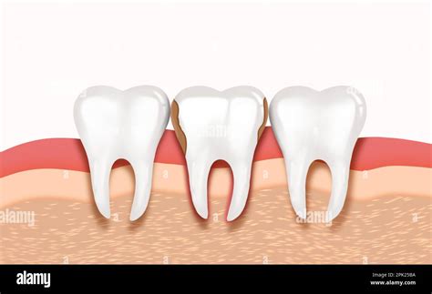 Infected Gum And Tooth Illustration Periodontal Disease Stock Photo