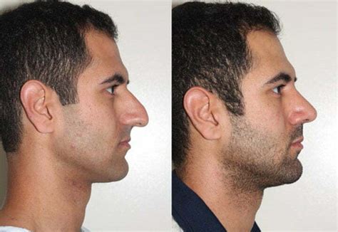 Rhinoplasty In Iran Iran Is Called The Paradise Of Cosmetic Surgeons”