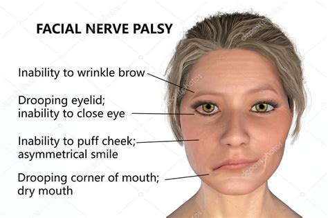 Parálisis del nervio facial, parálisis de Bell, ilustración 3D que ...