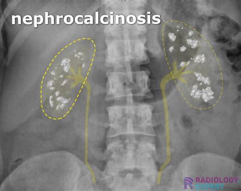 Abdominal X Ray