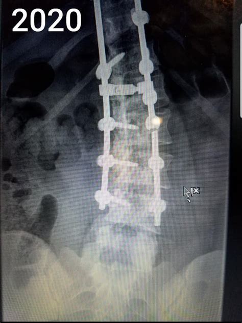 Hardware failure after spinal fusion. Would like to discuss details ...