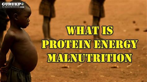 Protein-energy Malnutrition – Overview, Symptoms, Prevention and More ...