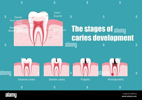 Stages of decay Stock Vector Images - Alamy