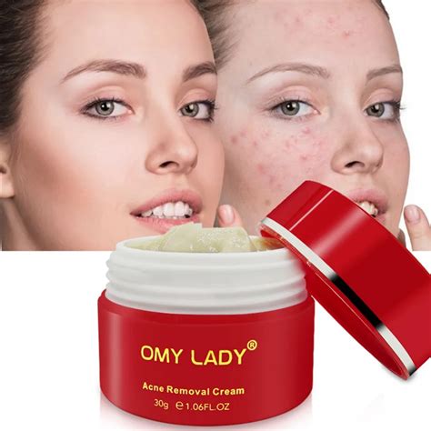 Anti Acne Cream Moisturizing Oil Control Shrinking Pores Smoothing Skin ...