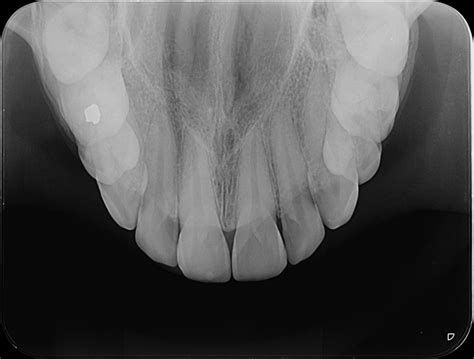 Cedro Radiologia RADIOGRAFIA OCLUSAL