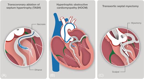 Schematic illustration of alcohol septal ablation and surgical myectomy ...