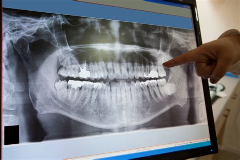 How Often Should I Have X Rays Taken Center For Restorative