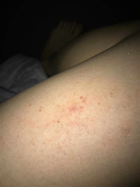 Rash On Thigh