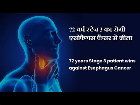 Best Esophageal Cancer Treatment Hospital in India | Barrett's ...