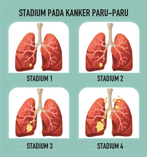 Kanker Paru Antara Ada Dan Tiada Edisi Dua