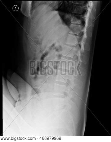 Lumbosacral Spine X- Image & Photo (Free Trial) | Bigstock