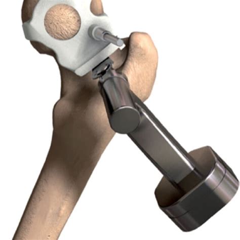 Femoral neck osteotomy cutting guide | Download Scientific Diagram