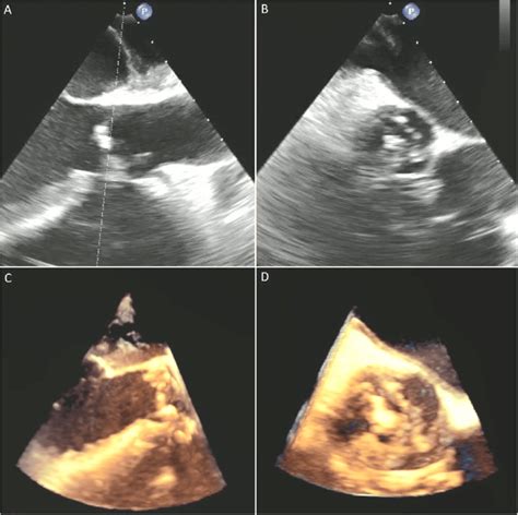 Transesophageal Echocardiography Tee Shows A Long Axis A And Download Scientific Diagram