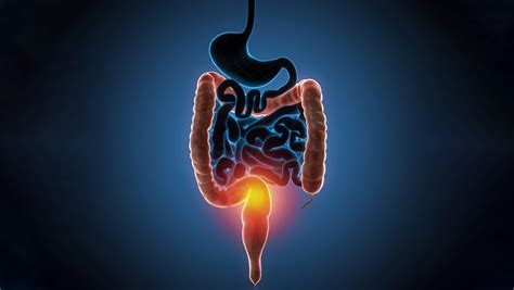 Retocolite Ulcerativa O Que Sintomas E Tratamento Md Sa De