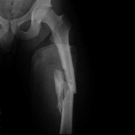 Leg Shortening Femoral Neck Fracture Icd 10