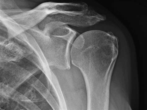 In Shoulder Radiology Musculoskeletal Key