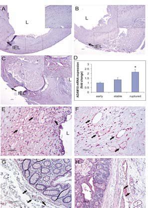 Immunohistochemical Staining Of Adam In Human Early A Advanced