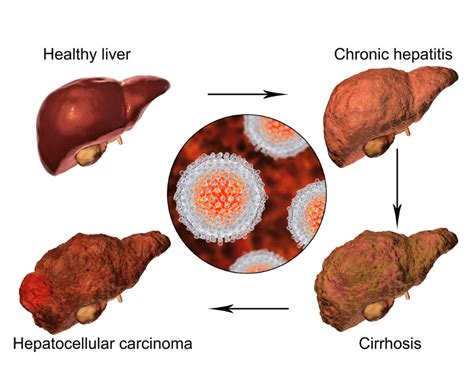 Unlocking The Mysteries Of Fatty Liver Disease Gidoc Cape Town