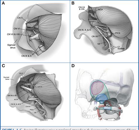 Figure From The Craniocaudal Extension Of Posterolateral Approaches