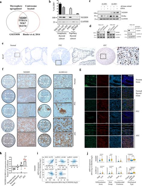 NEDD9 Is Upregulated In ALDH ATC Cells And NEDD9 ALDH1A3 Are